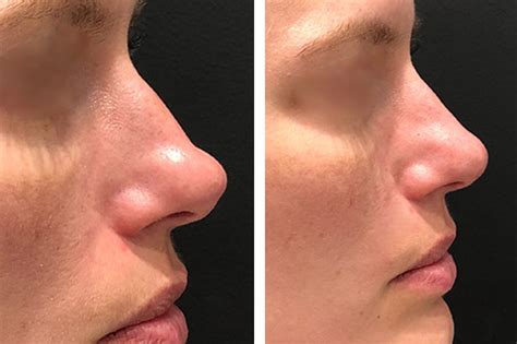 Or it may be caused by an injury, or damage from previous treatments. . How to get a free nose job with a deviated septum